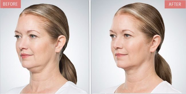 Before and After Kybella Treatment