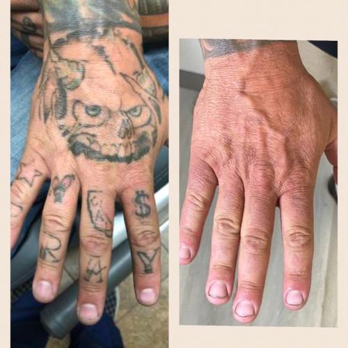 LASER-TATTOO-REMOVAL-TEMECULA