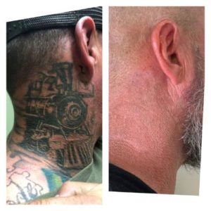TEMECULA-NECK-TATTOO-REMOVAL