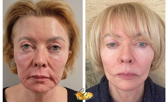 NeoGen-Before-and-After-Photo NeoGen PSR