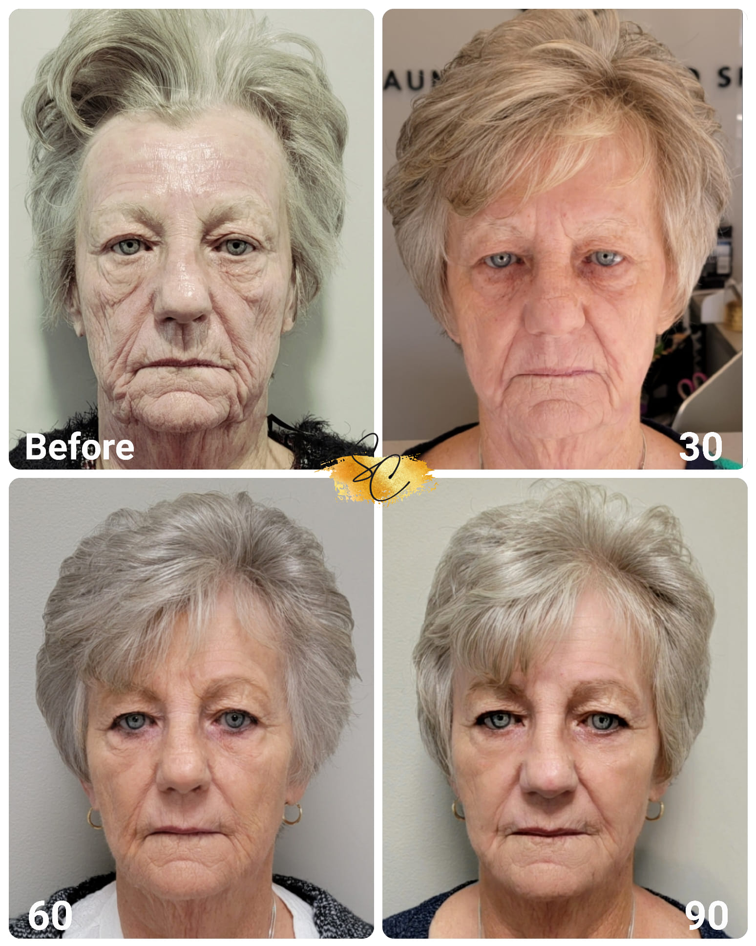 NeoGen-PSR-at-De Luz-Medical-Aesthetics (2) NeoGen PSR