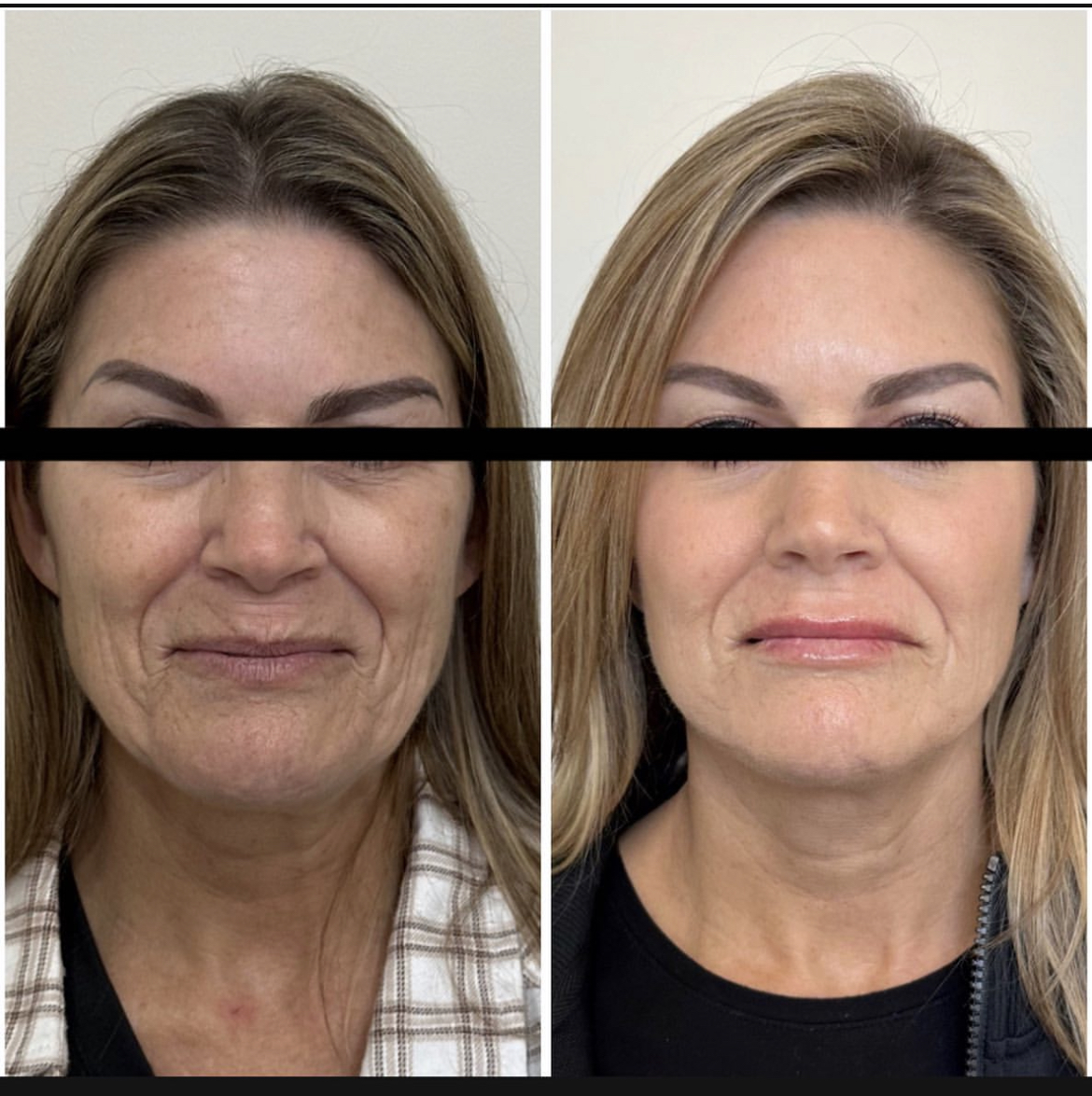 NeoGen-PSR-at-De Luz-Medical-Aesthetics (3) NeoGen PSR
